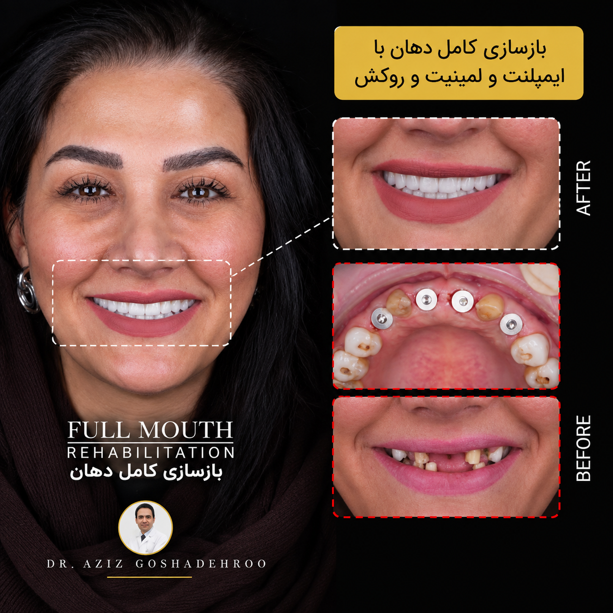 بازسازی کامل دهان با ایمپلنت روکش و لمینیت
